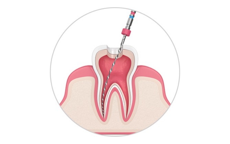 Blog Endodental Therapy