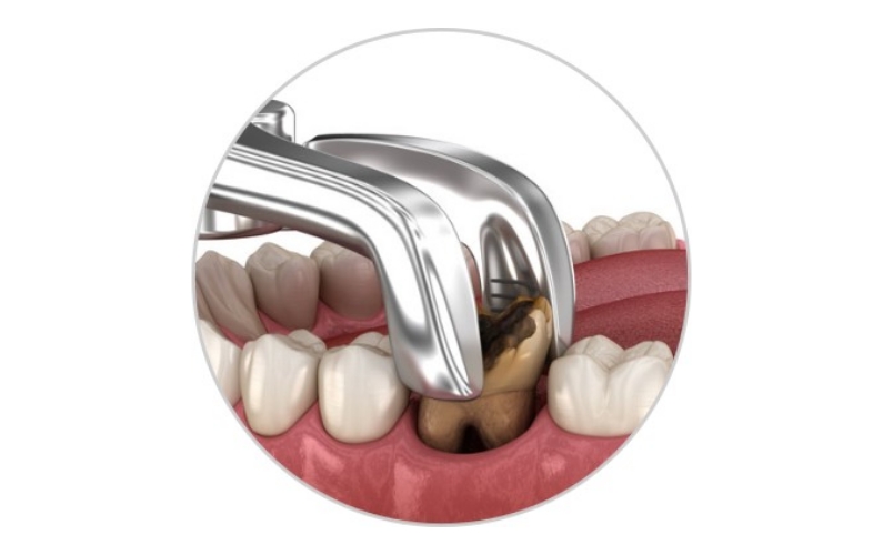 Blog Tooth Extraction