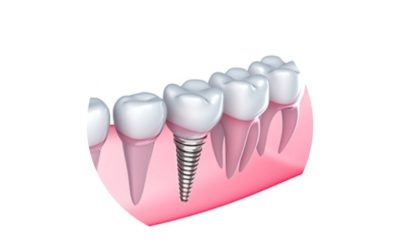 Οδοντικά Εμφυτεύματα
