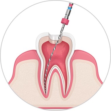 Endodental Therapy