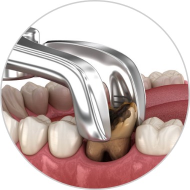 Tooth Extraction