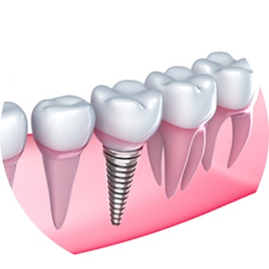 Tooth-Implants